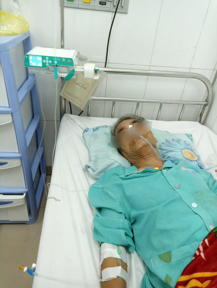 BN sử dụng kỹ thuật giảm đau ngoài màng cứng