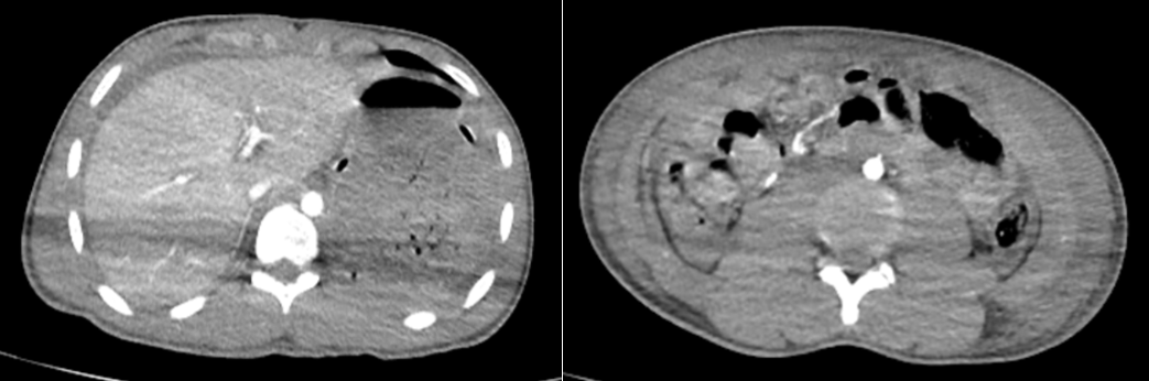 Hình ảnh chụp cắt lớp vi tính ổ bụng lúc mới vào viện