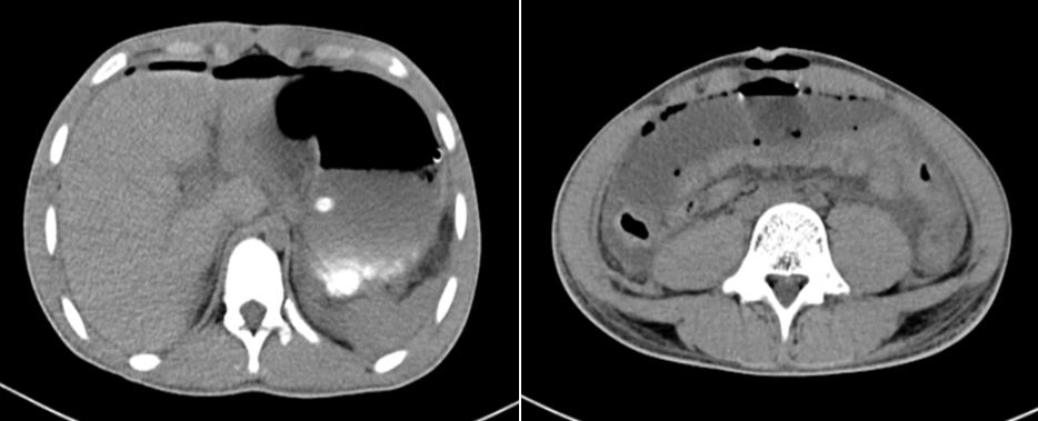 Hình ảnh hơi tự do ổ phúc mạc vào ngày thứ 12 sau nhập viện trên phim chụp cắt lớp vi tính