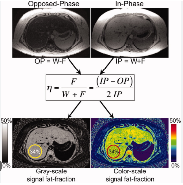 Hình 2. Ứng dụng kĩ thuật MultiEcho trong định lượng gan nhiễm mỡ