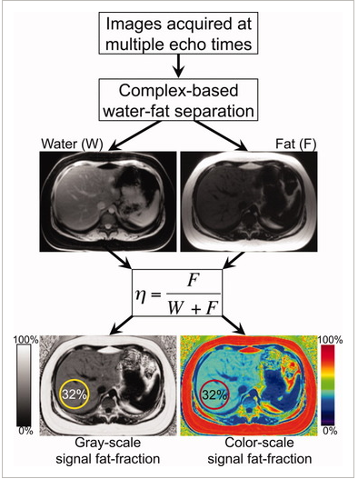 Hình 3. Ứng dụng kĩ thuật MultiEcho trong định lượng gan nhiễm mỡ