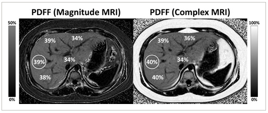 Hình 4. Đo chỉ số SI ở 6 vị trí khác nhau trong gan để định lượng gan nhiễm mỡ