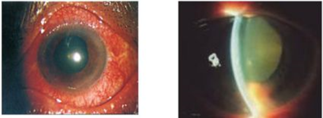 Glôcôm - Kẻ đánh cắp thị lực thầm lặng