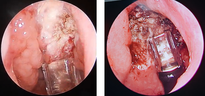 Hốc mổ trong và sau nạo VA bằng dao Plasma