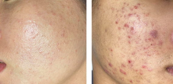 SẤN: Không nhân, kích thước <5mm