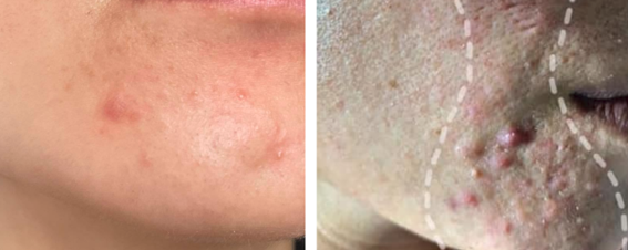 CỤC: Không nhân, kích thước > 5mm