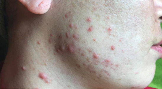 Cục + Sẩn trứng cá