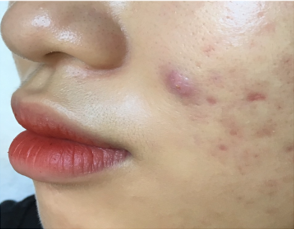 NANG: Có nhân, kích thước >5mm