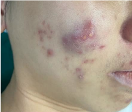 Nhiều nang tập trung cụm