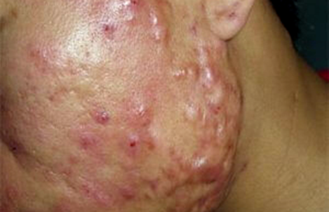 (Trứng cá mạch lươn)