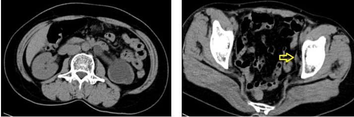 Hình 1 : Thận trái ứ nước độ 4 và vị trí niệu quản hẹp (mũi tên vàng)