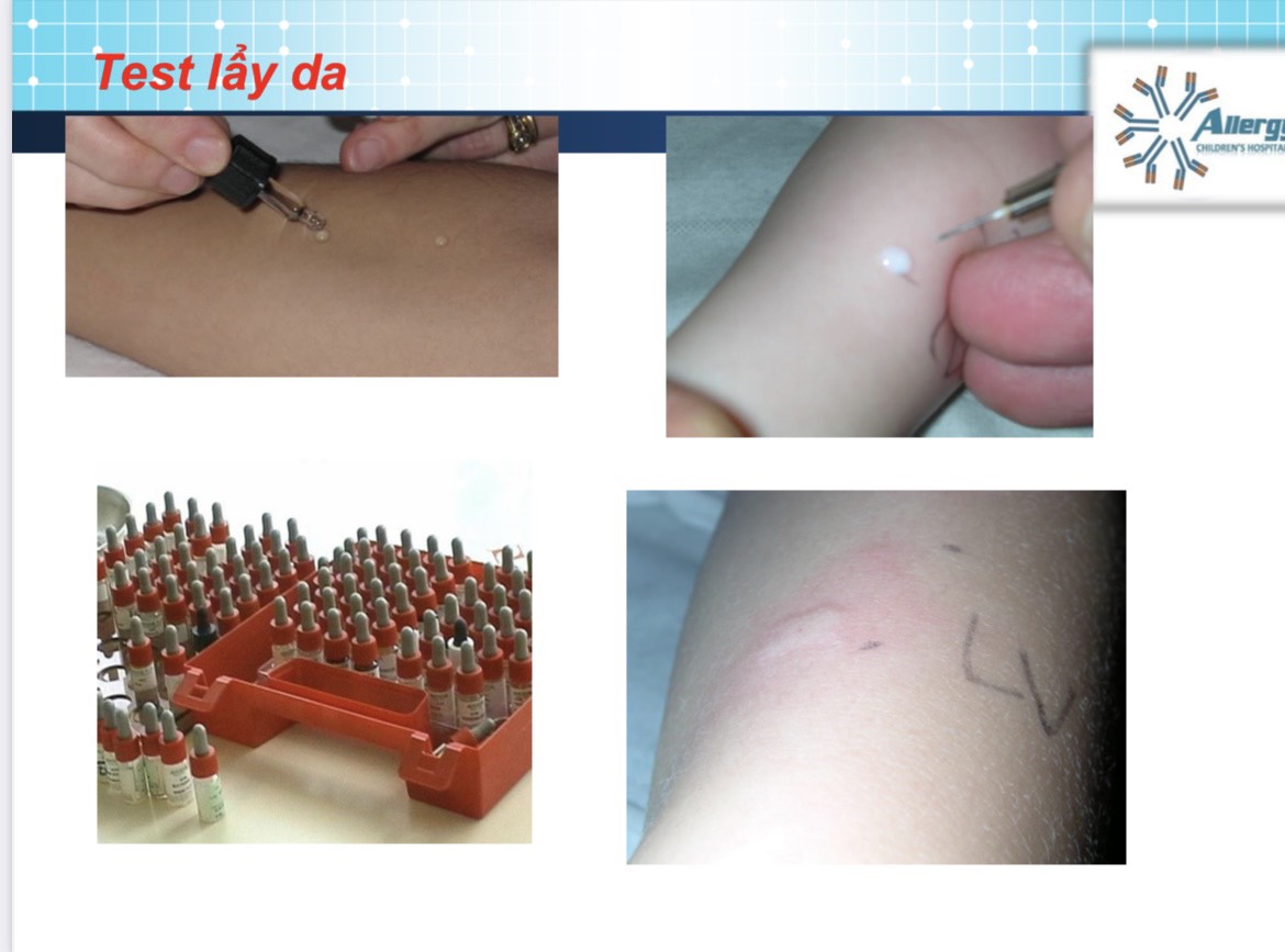 Test lẫy da trên bệnh nhân dị ứng đạm sữa bò