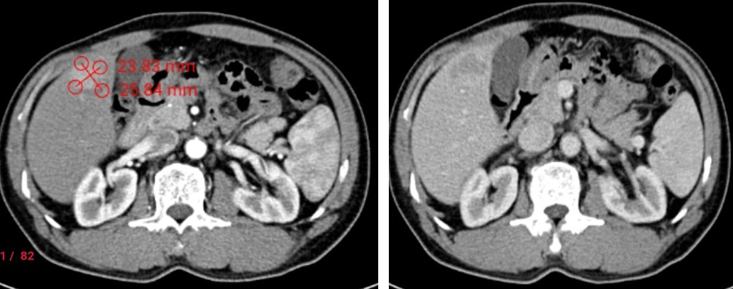 Hình ảnh khối U kích thước khoảng 23x25mm ngấm thuốc mạnh thì động mạch, thải thuốc nhanh thì tĩnh mạch trên cắt lớp vi tính