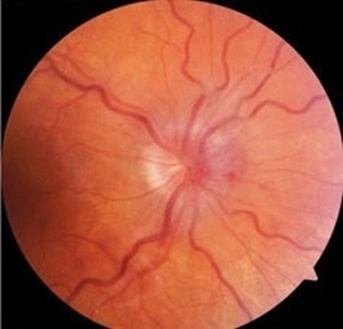 Gai thị bị phù (viêm TTK)