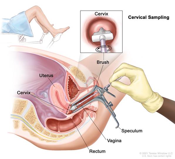 Soi cổ tử cung và lấy mẫu làm xét nghiệm tế bào học cổ tử cung (Pap test).