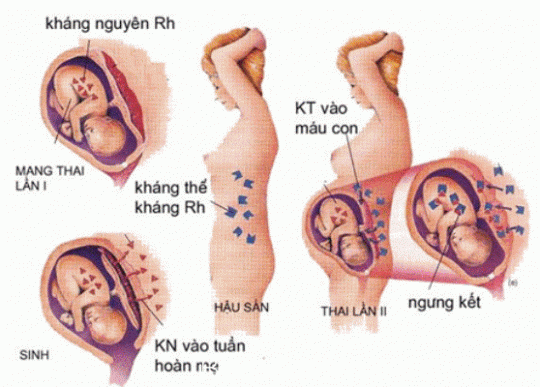 Phát hiện kháng thể kháng Rh (anti-D)