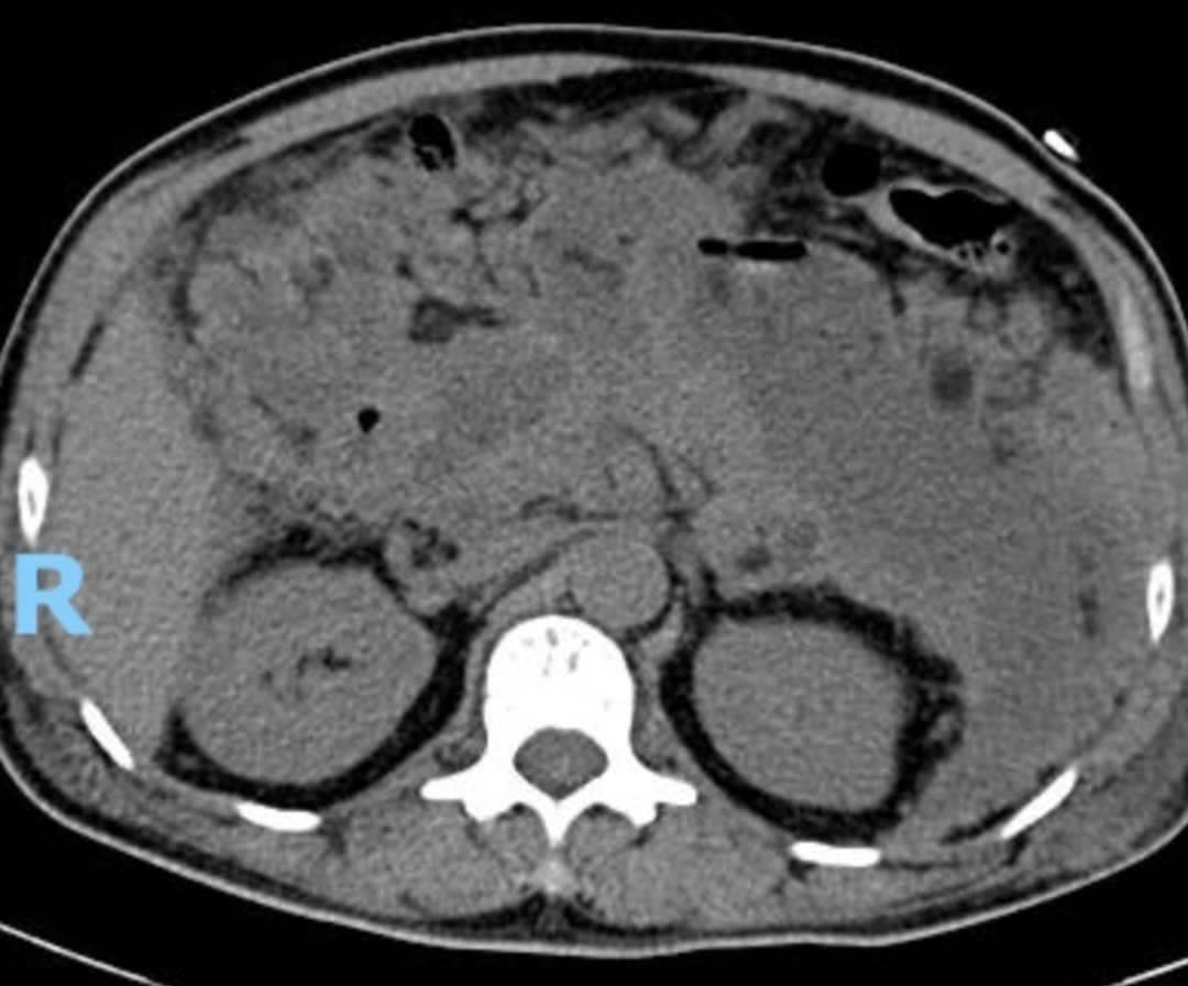 nguoi dan ong viem tuy hoai tu hoi sinh ngoan muc sau 70 ngay 1 17444140405081570244767