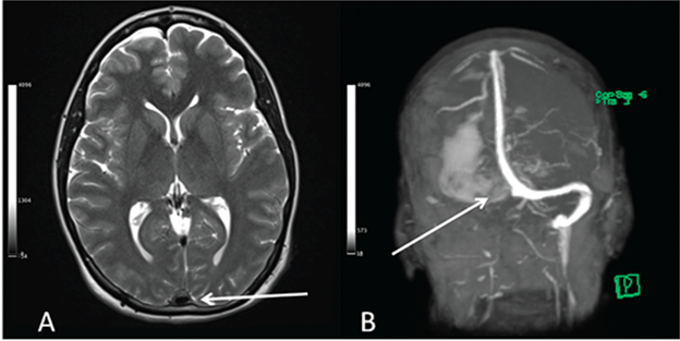 Hình 2: Chụp cộng hưởng từ cho thấy huyết khối ở hội lưu xoang (mũi tên trắng ở A) và ở xoang ngang (mũi tên trắng ở B).
