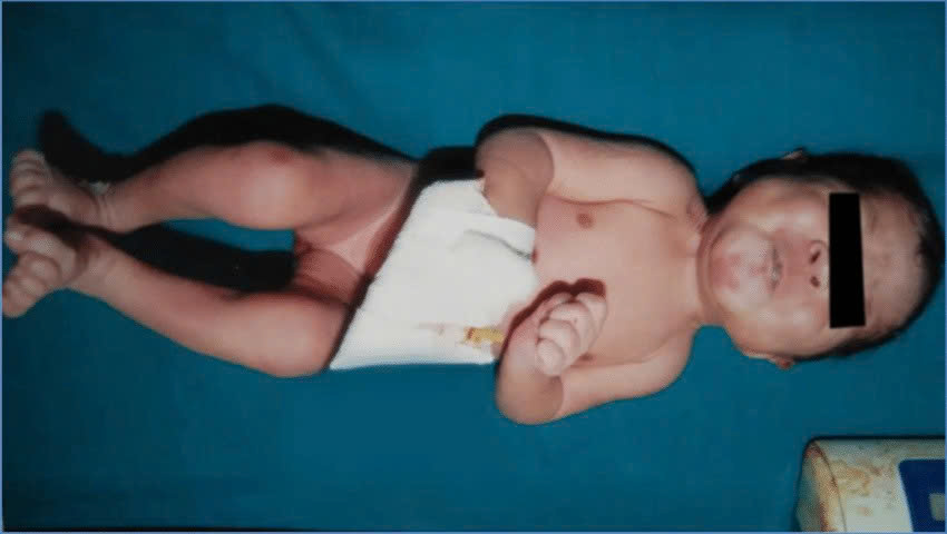 Chú thích ảnh: Cơn co cứng điển hình