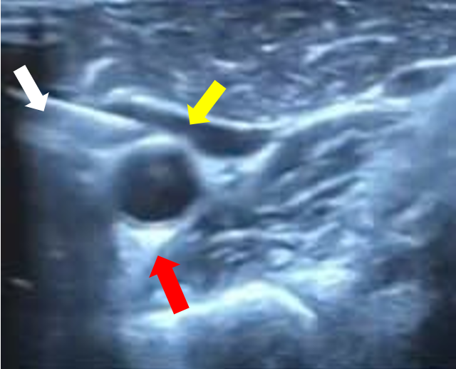 Chọc hút hạch nghi ngờ sát động mạch cảnh dưới hướng dẫn siêu âm (mũi tên trắng: kim sinh thiết, mũi tên vàng: hạch nghi ngờ, mũi tên đỏ: Động mạch cảnh)